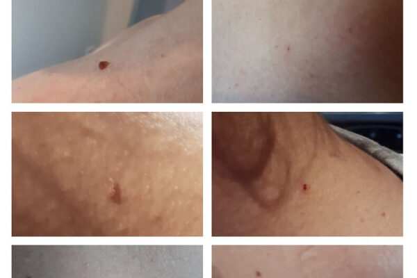 body t. REMOVING SMALL SKIN CHANGES 1 pi