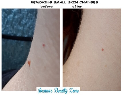 body t. removing small skin changes 3 pi