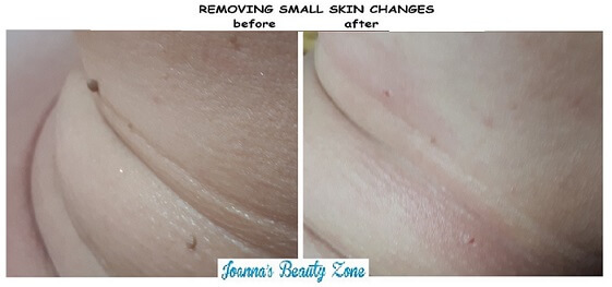 body t. removing small skin changes 4 pi