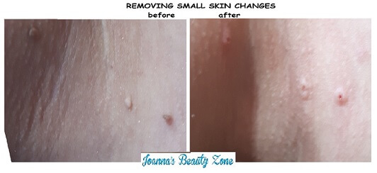 body t. removing small skin changes 5 pi